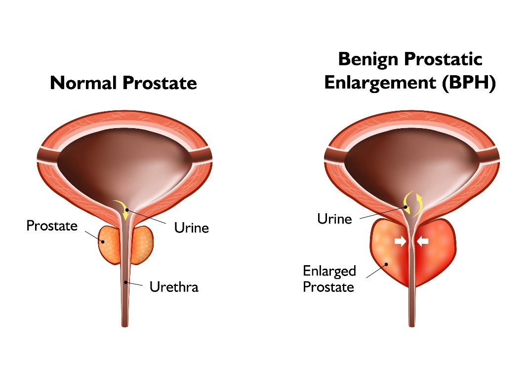 Normal Prostate versus Benign Prostatic Enlargement (BPH)