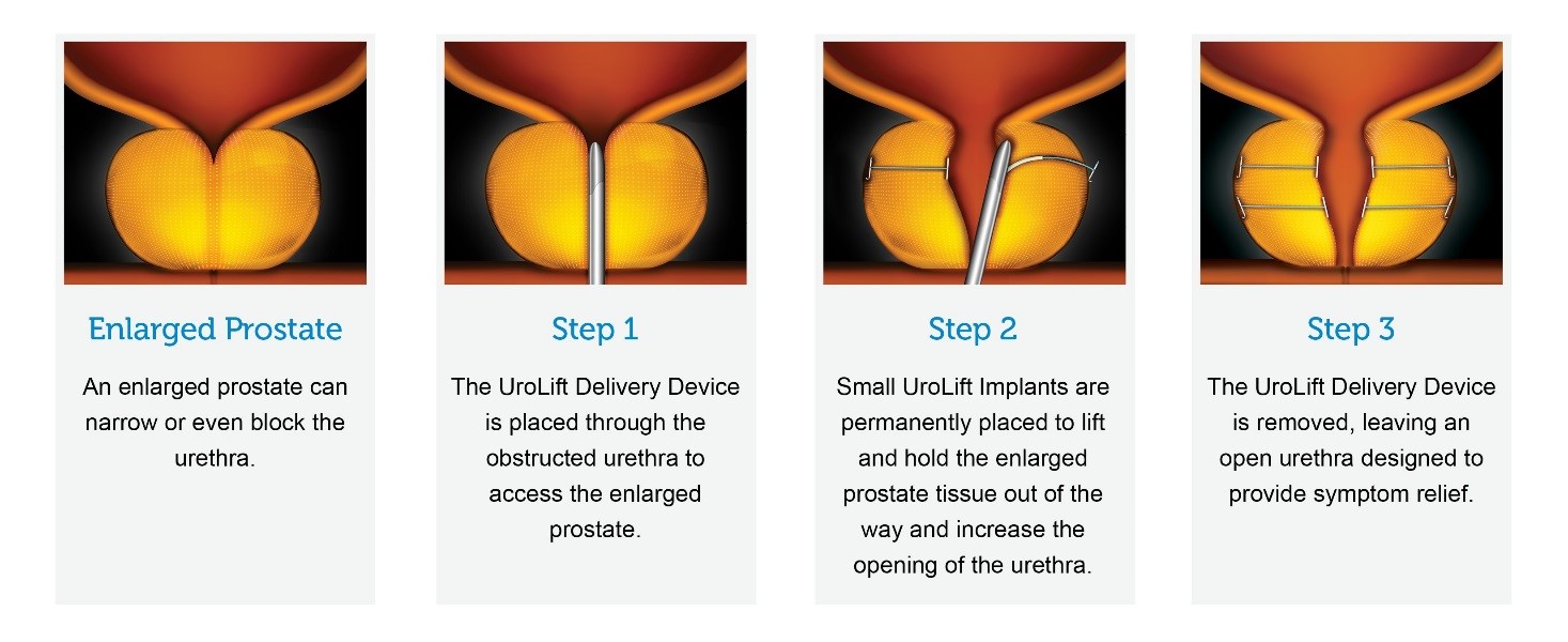 The UroLift<sup>®</sup> System Steps